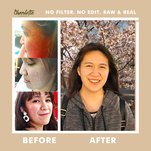 (Set of 2) Charlotte Organics Acne Clear Oats Solution Soap My Store