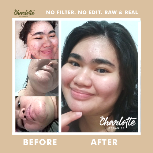 (Set of 3) Charlotte Organics Acne Clear Oats Solution Soap My Store