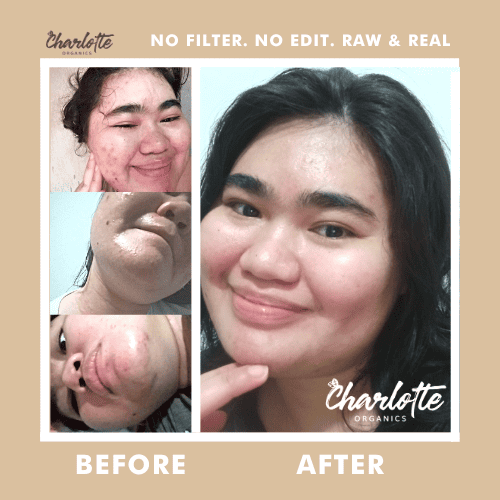 (Set of 5) Charlotte Organics Acne Clear Oats Solution Soap My Store