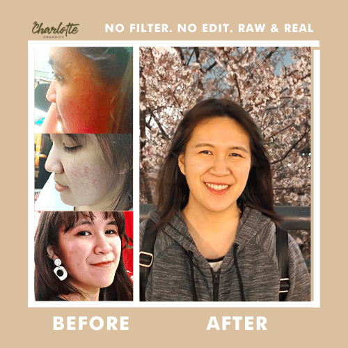 (Set of 5) Charlotte Organics Acne Clear Oats Solution Soap My Store